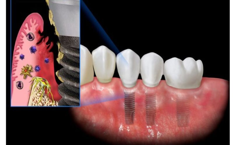 nguyen-nhan-hoi-mieng-khi-trong-implant