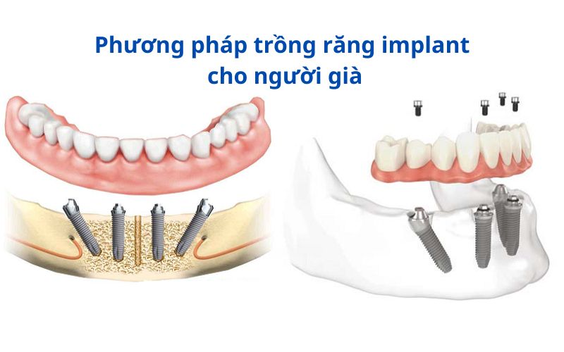 phuong-phap-trong-rang-implant-cho-nguoi-gia