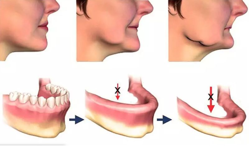 tai-sao-nen-trong-rang-implant-cho-nguoi-gia