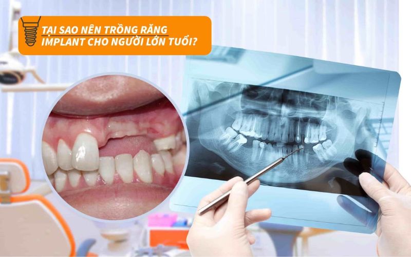 tai-sao-nen-trong-rang-implant-cho-nguoi-gia-