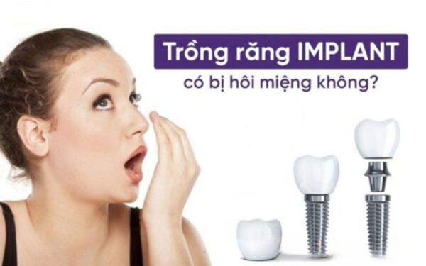 trong-rang-implant-co-bi-hoi-mieng-khong
